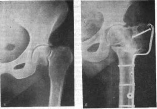 Ложный сустав шейки бедра. Проявления и лечение ложного сустава шейки бедра