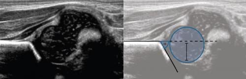 УЗИ тазобедренного сустава методика. УЗИ тазобедренных суставов у младенцев