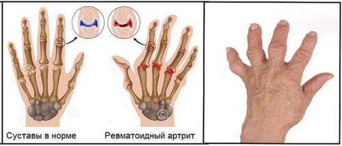 Шишки на фалангах указательного. Виды и симптомы