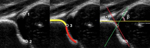 УЗИ тазобедренного сустава методика. УЗИ тазобедренных суставов у младенцев