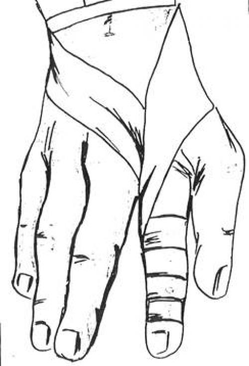 Варежка Повязка. Алгоритм наложения повязки «варежка» на все пальцы кисти.