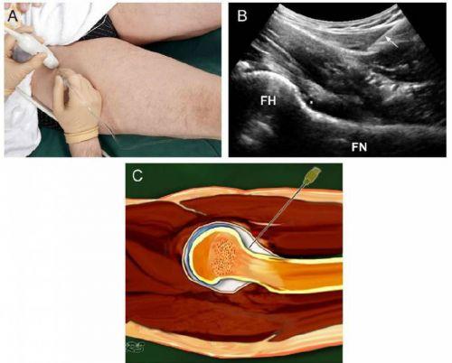 Уколы в колени гиалуроновой кислоты. Гиалуроновая кислота для суставов 05