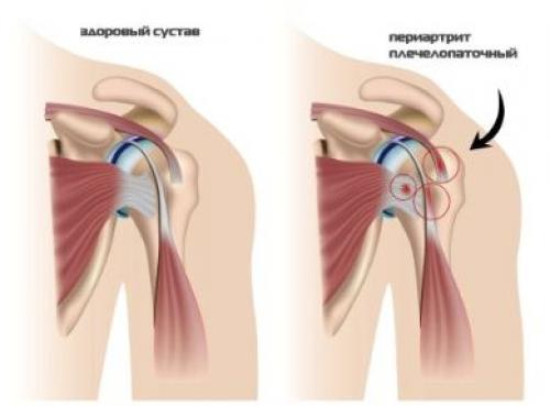 Боль и хруст в плечах. Почему болит и хрустит плечо?