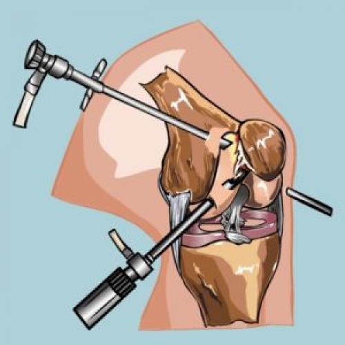 Разрыв 3 степени заднего рога медиального мениска. Виды, классификация 01 Разрыв 3 степени заднего рога медиального мениска. Виды, классификация 01