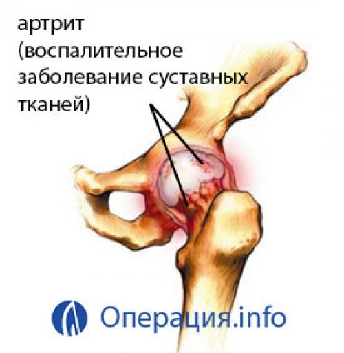 Тазобедренный сустав сколько стоит. Тазобедренный сустав, протез: цена 03