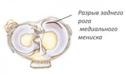Дегенеративные изменения заднего рога медиального мениска 3 степени. Дегенеративные повреждения заднего рога медиального мениска