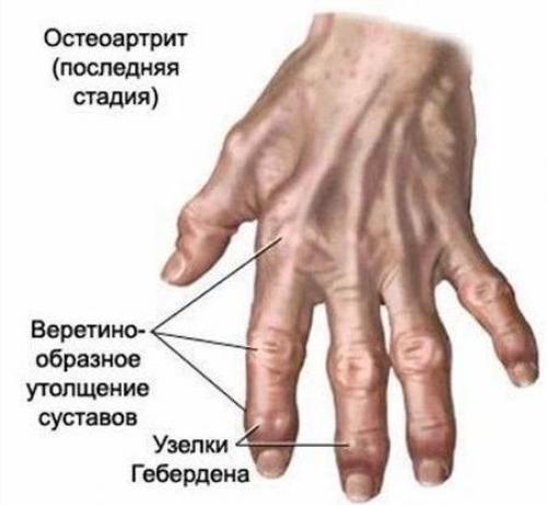 Шишка на сгибе пальца руки. Шишки на фалангах пальцев рук
