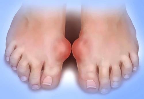 Артрит правого голеностопного сустава код по мк.  Артрозо-артрит голеностопного сустава: код мкб-10, симптомы и лечение