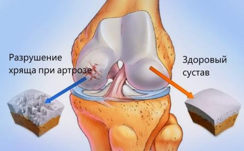 Артрит правого голеностопного сустава код по мк.  Артрозо-артрит голеностопного сустава: код мкб-10, симптомы и лечение