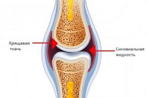 Дегенеративные изменения заднего рога медиального мениска 3 степени. Дегенеративные повреждения заднего рога медиального мениска
