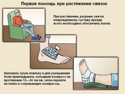Первая помощь при разрыве связок. Первая помощь при растяжении связок и вывихах