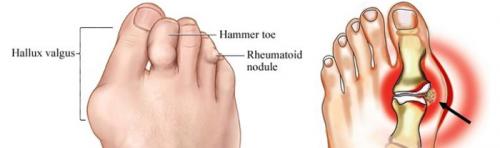 Наросты на пальцах ног сверху. Причины возникновения косточки на пальце ноги сверху и методы лечения