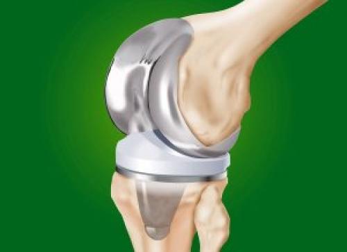 Дегенеративные изменения заднего рога медиального мениска 3 степени. Дегенеративные повреждения заднего рога медиального мениска