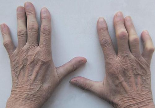 Увеличение косточки на пальце руки. Какие заболевания провоцируют появление шишек 01