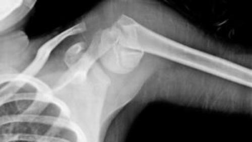 Реабилитация после перелома большого бугорка плечевой кости. Что такое перелом большого бугорка плечевой кости, приводим примеры