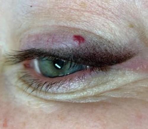 Внезапный синяк на веке. Появился синяк на верхнем веке без причины