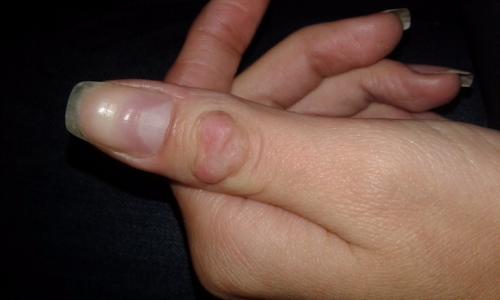 Увеличение косточки на пальце руки. Какие заболевания провоцируют появление шишек 02