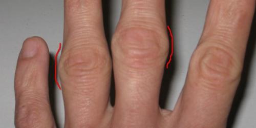 Шишки на суставах пальцев рук лечение. Шишки на пальцах рук 04 Шишки на суставах пальцев рук лечение. Шишки на пальцах рук 04