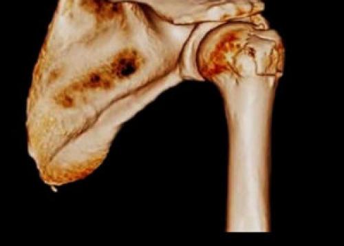 Реабилитация после перелома большого бугорка плечевой кости. Что такое перелом большого бугорка плечевой кости, приводим примеры