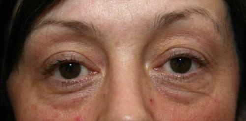 Фиолетовый синяк на веке. С чем связано появление синяков на веках и что предпринять в этом случае