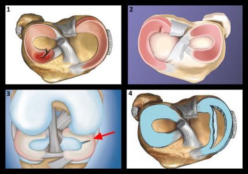 Повреждение переднего рога медиального мениска. Виды повреждений, три степени по Столлеру