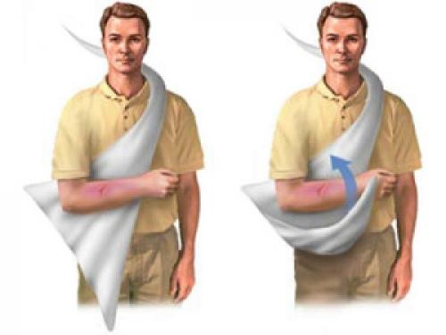 Фиксирующая повязка на плечо. Повязка на плечевой сустав