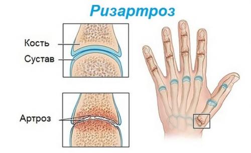 На пальце руки появился бугорок. Симптомы