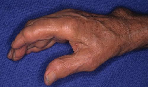 Шишка на пальце руки болит. Какие виды встречаются