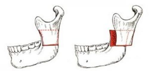 Остеотомия верхней и нижней челюсти показания. Описание лечебной процедуры