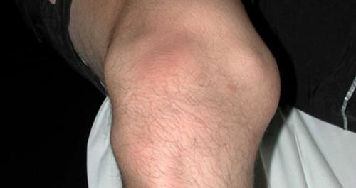 Препараты для восстановления связок колена. Уколы для восстановления связок колена