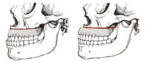Остеотомия верхней и нижней челюсти показания. Описание лечебной процедуры