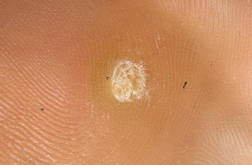 На сгибе пальца ноги нарост в виде мозоли. Мозоль на пальцах ног