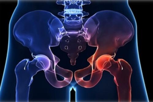 Импрессионное повреждение это. Импрессионный перелом мыщелка бедренной кости