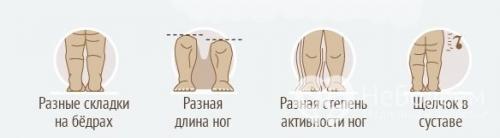 Дисплазия тазобедренного сустава у детей 5 лет. Симптомы дисплазии тазобедренных суставов