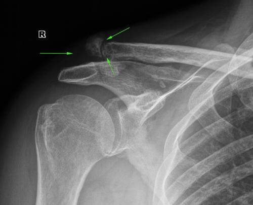 Может ли срастись ложный сустав. Из жизни рентгенолога. Част.  Люди с высоким болевым порогом и ложные суставы
