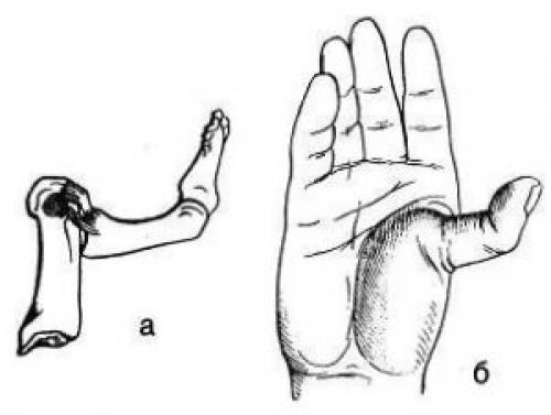 Пястно-фаланговый сустав. Пястно-фаланговое сочленение
