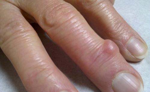 На сгибе пальца. Какие виды встречаются