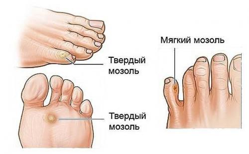 На сгибе пальца ноги нарост в виде мозоли. Мозоль на пальцах ног
