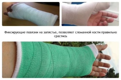 Операция при переломе лучевой кости со смещением. Лечение переломов лучевой кости