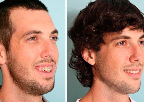 Остеотомия челюсти реабилитация. Остеотомия верхней челюсти