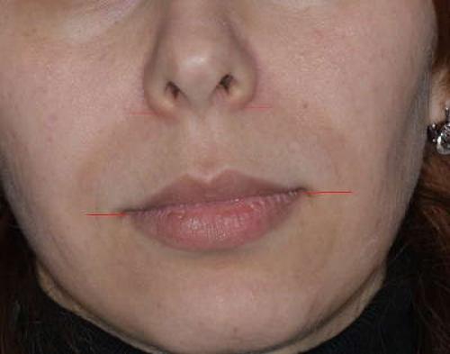 Несимметричная челюсть. Асимметрию лица можно исправить без пластической операции