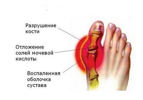 Большие косточки. Общая симптоматика