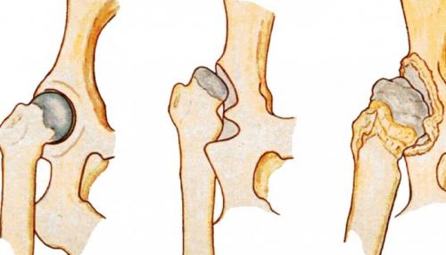 Дисплазия тазобедренных суставов у взрослых. Классификация