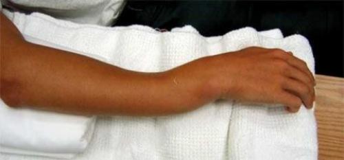 Сколько болит рука после перелома лучевой кости. Как долго болит рука после перелома?