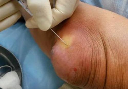 Отек локоть, но не болит. Бурсит