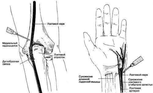 Болит нерв в локтевом суставе