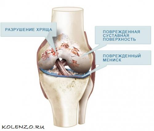 Лечение коленного сустава народными средствами. Народные средства от артроза колена: эффективные рецепты