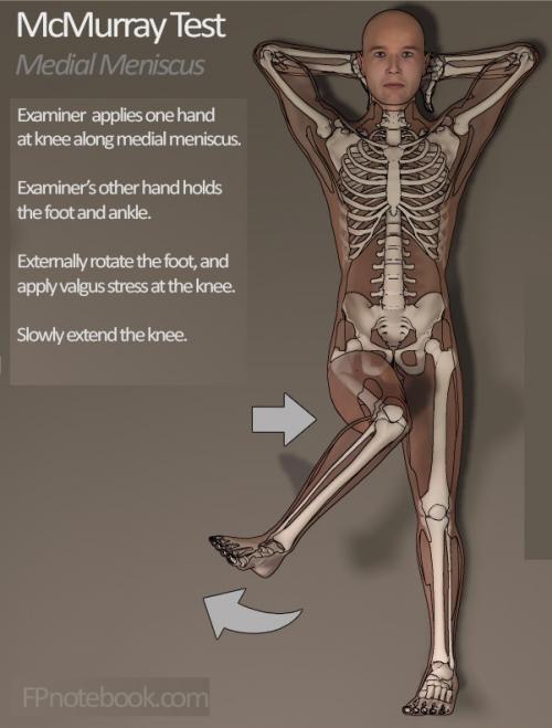 Наиболее характерным симптомом при свежем разрыве мениска является. Симптомы повреждения мениска 02 Наиболее характерным симптомом при свежем разрыве мениска является. Симптомы повреждения мениска 02