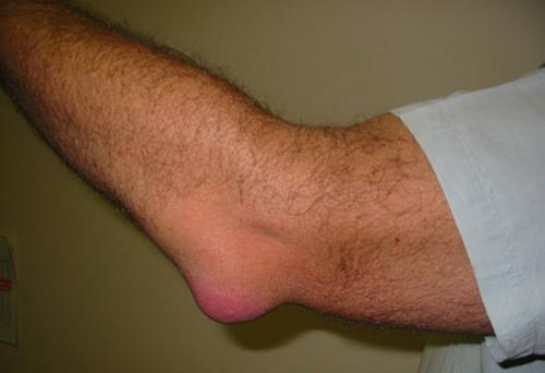 Отек локоть, но не болит. Бурсит