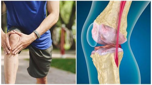 Гонартроз 3 степени коленного сустава инвалидность. Характерные признаки 03 Гонартроз 3 степени коленного сустава инвалидность. Характерные признаки 03